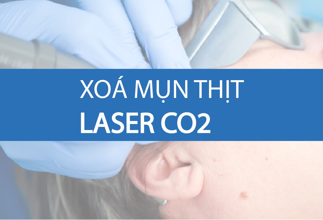 xoá mụn thịt laser