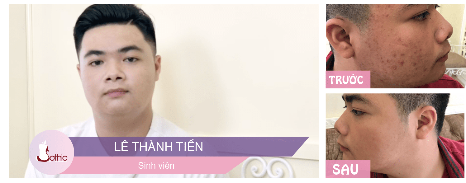 điều trị mụn hiệu quả cấp tốc