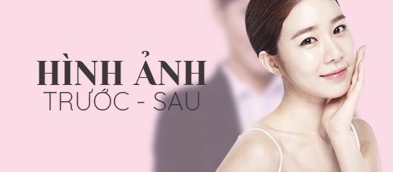 hình ảnh trước sau sothic
