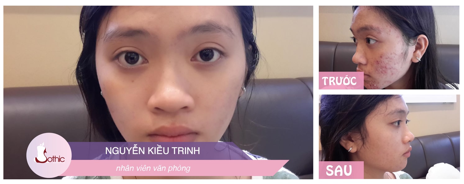 điều trị mụn hiệu quả cấp tốc