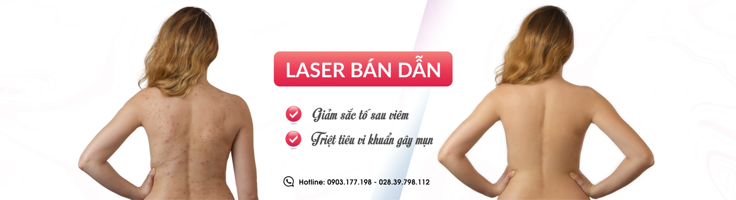laser bán dẫn triệt tiêu vi khuẩn gây mụn