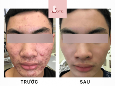 Khách hàng trị mụn tại Sothic