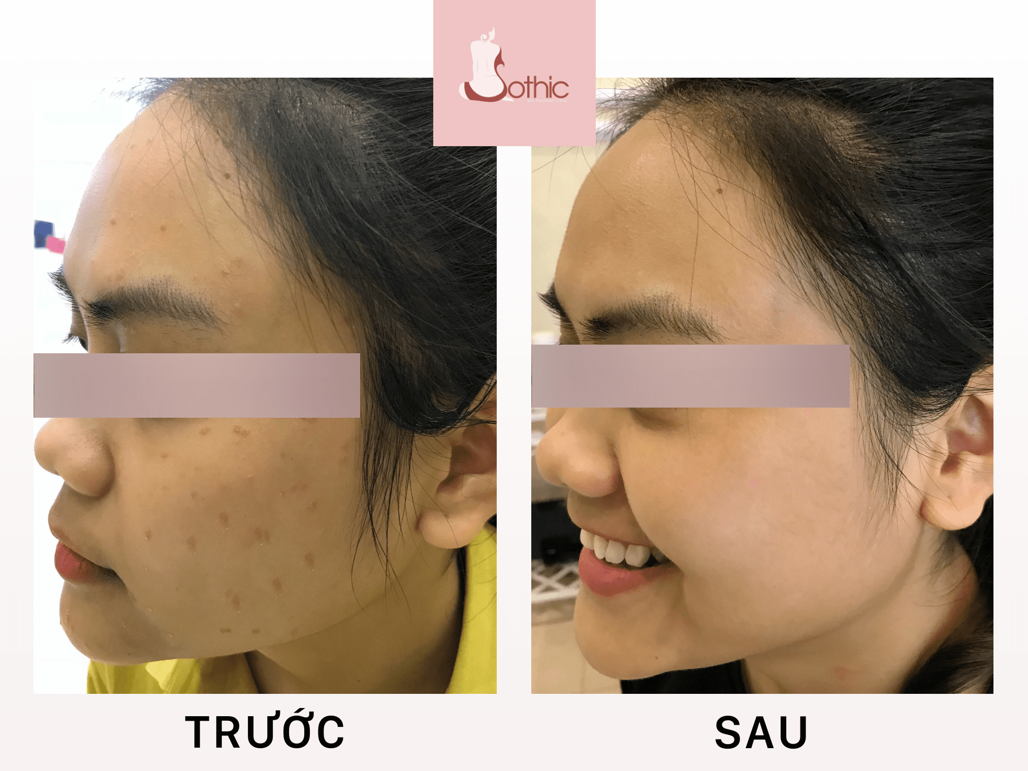Khách hàng trị mụn tại Sothic