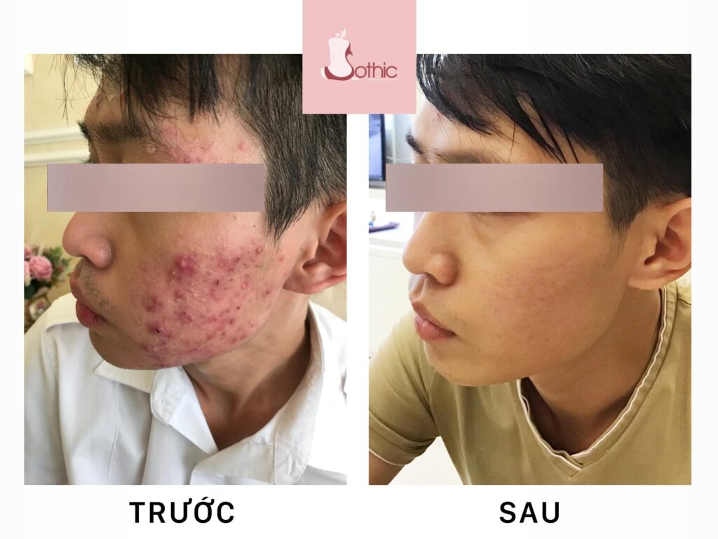 khách hàng trị mụn tại Sothic