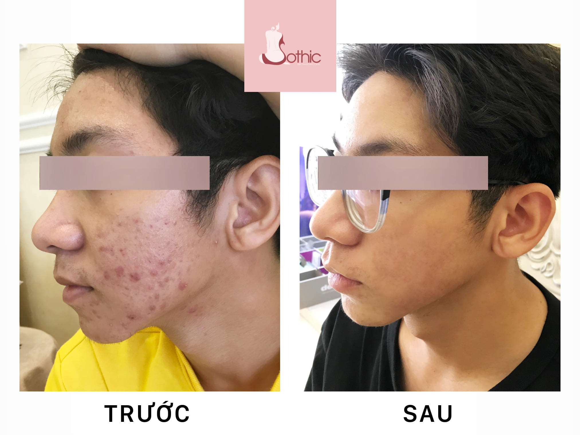 khách hàng trị mụn tại Sothic